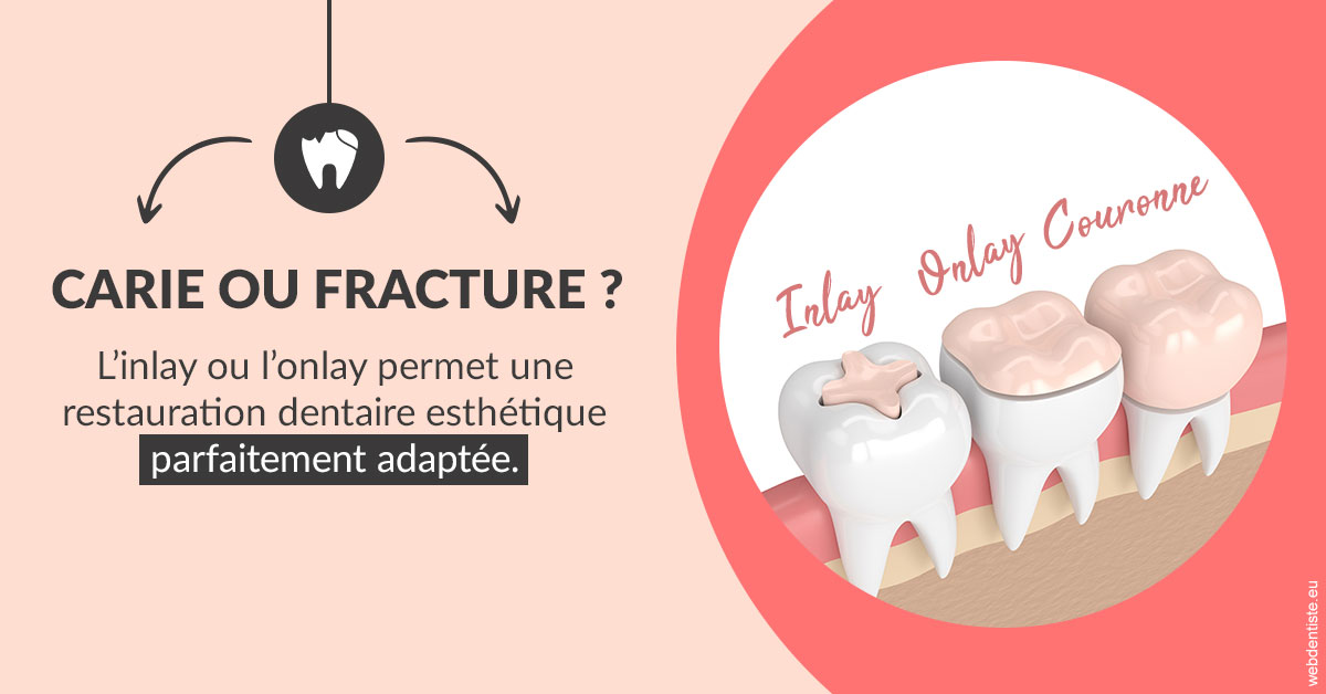 https://dr-poirier-yves.chirurgiens-dentistes.fr/T2 2023 - Carie ou fracture 2