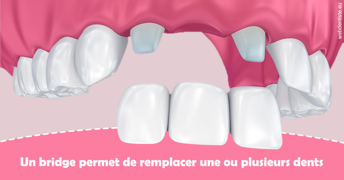 https://dr-poirier-yves.chirurgiens-dentistes.fr/Bridge remplacer dents 2