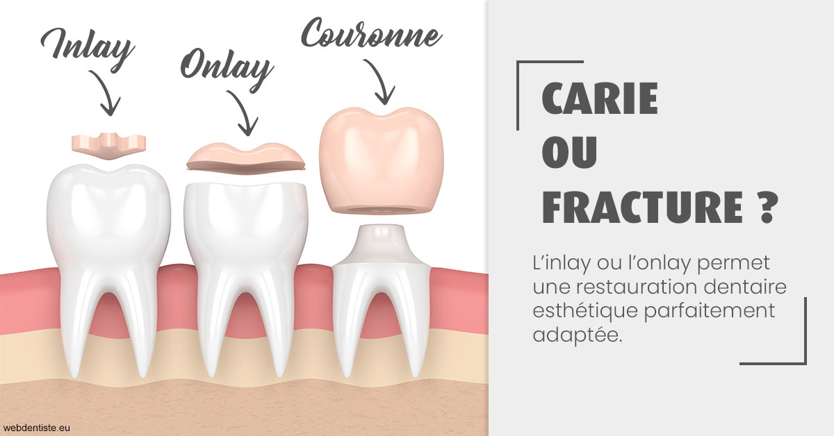https://dr-poirier-yves.chirurgiens-dentistes.fr/T2 2023 - Carie ou fracture 1