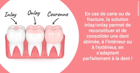 https://dr-poirier-yves.chirurgiens-dentistes.fr/L'INLAY ou l'ONLAY 2