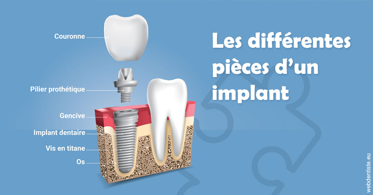 https://dr-poirier-yves.chirurgiens-dentistes.fr/Les différentes pièces d’un implant 1